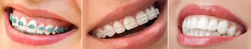 Types of Braces