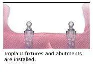 Implant-supported denture