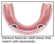 Implant-supported denture