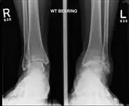 Ankle Replacement — Ankle Arthritis