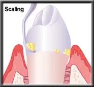 Should I Get Root Planing and Scaling (“deep cleaning”) from the General  Dentist or Periodontist?: Willow Glen Dental Specialists: Periodontists