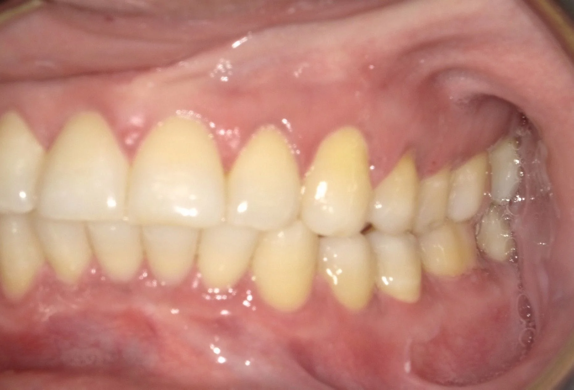 Before And After North York Orthodontics