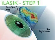 iLASIK - step 1