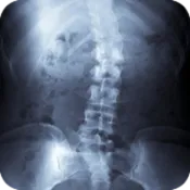 scoliosis_chiropractic.png