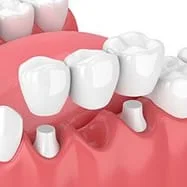 illustration of three unit dental bridge and crowns replacing missing tooth, dental crown Baton Rouge, LA