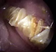 Guinea pig malocclusion of cheek teeth