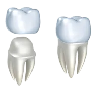 illustration of crown being placed over prepared tooth, dental crowns Charlotte, NC dentist