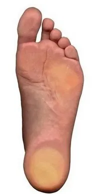 Flat Feet - Walk This Way Podiatry