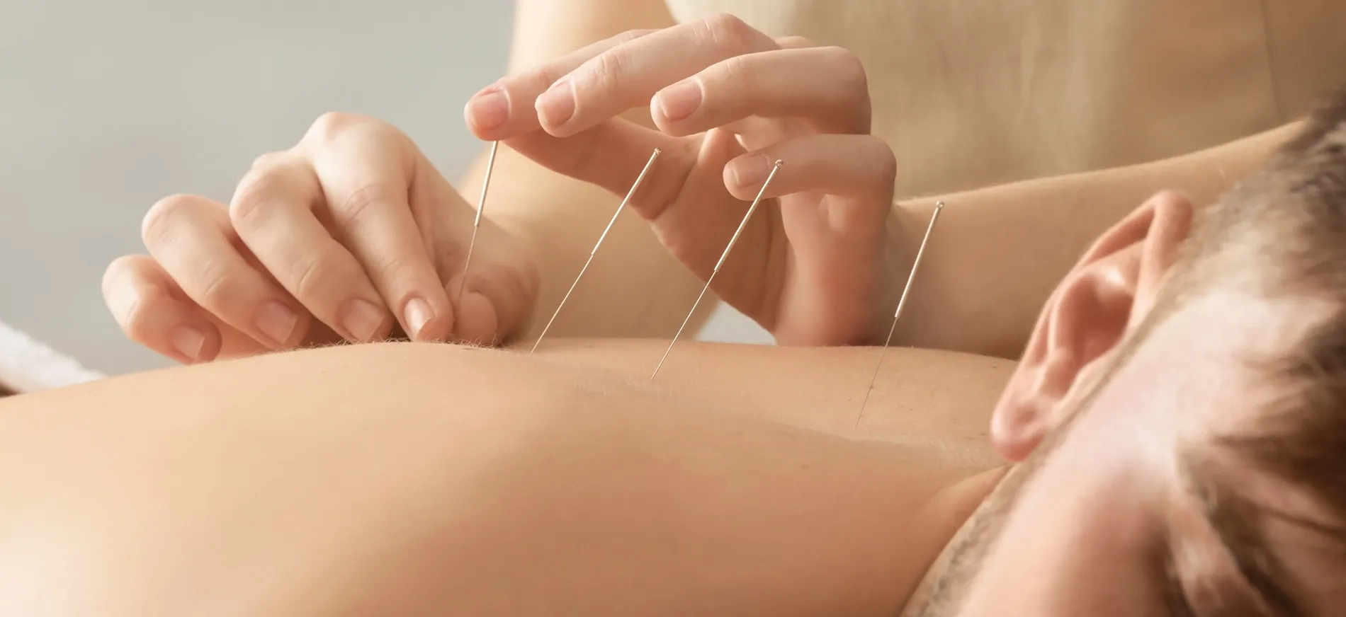 Acupuncture