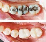row of teeth with metal fillings, then image showing same teeth with composite tooth colored fillings Mahwah, NJ