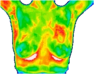 Ductal Carcinoma In Situ (DCIS) left breast