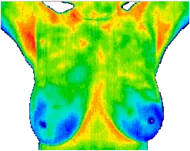 Normal symmetry of healthy breasts