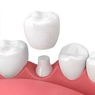 illustration of crown fitting over tooth, dental crown Baton Rouge, LA dentist