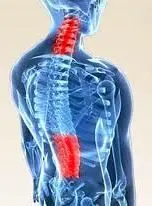 Spinal stenosis Information