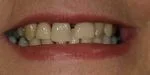 close up of woman's smile with gaps and uneven due to ill fitting dentures Cumberland Park SA dentist