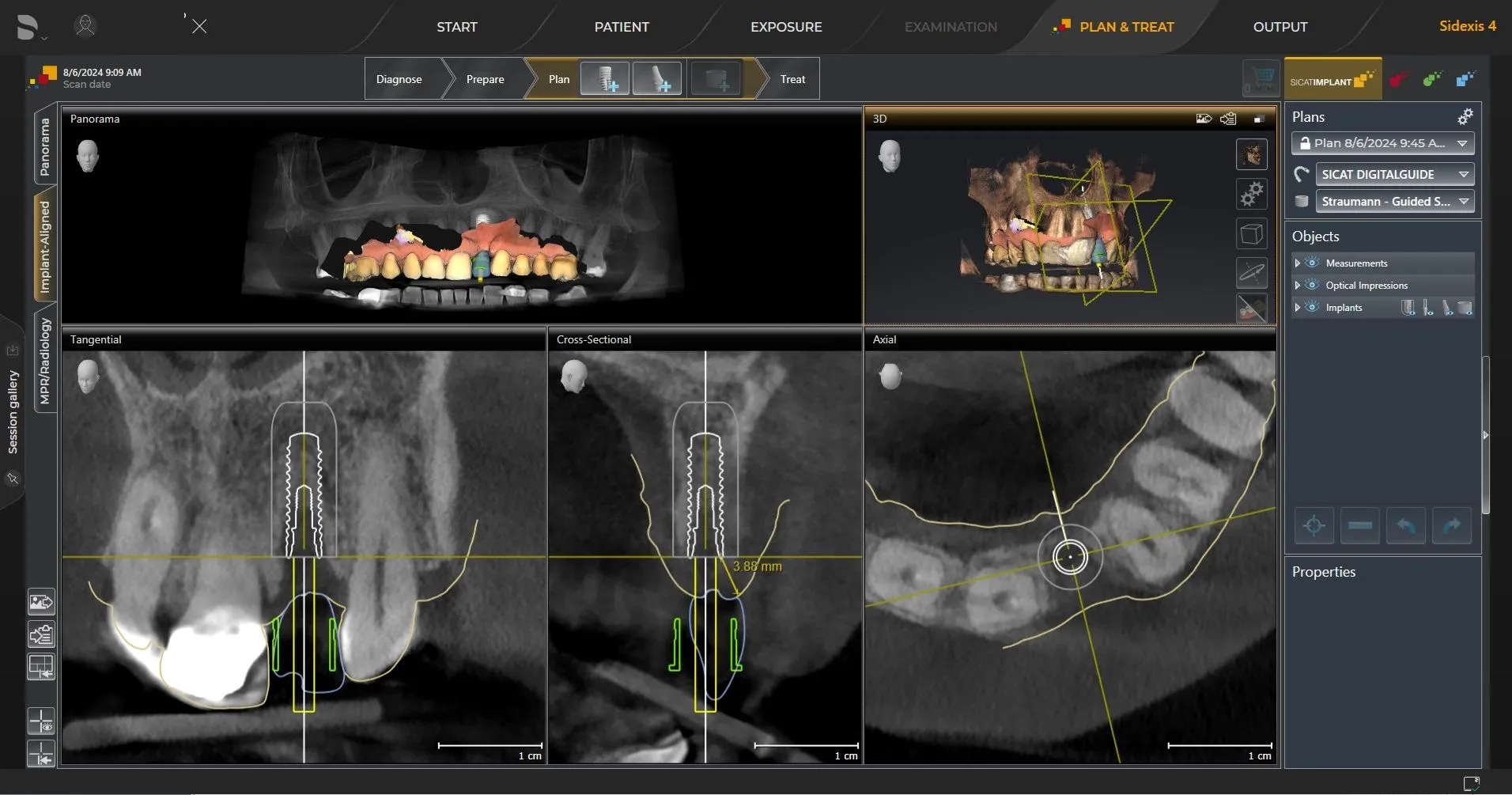 implant