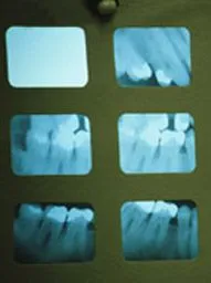 Oraltech Xrays