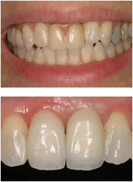 dental implants