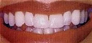 Teeth_Whitening_after.jpg