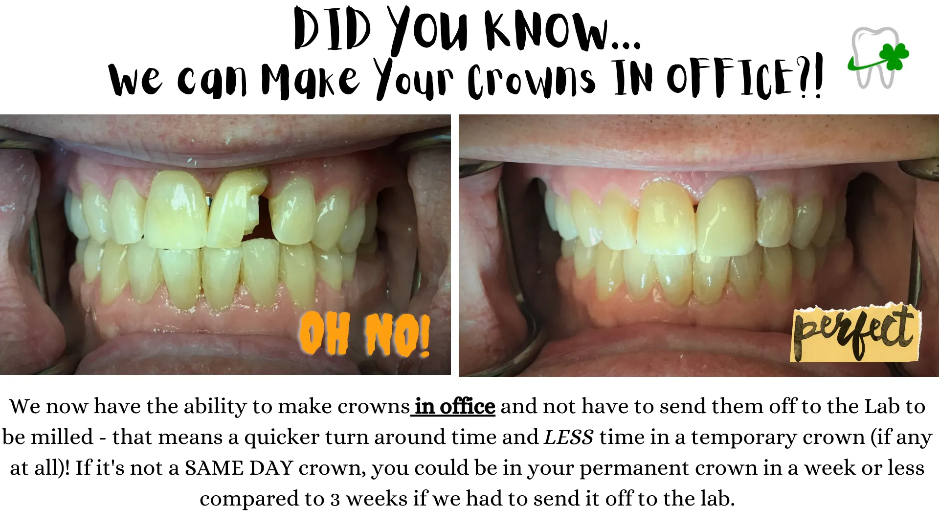 same day crowns in office