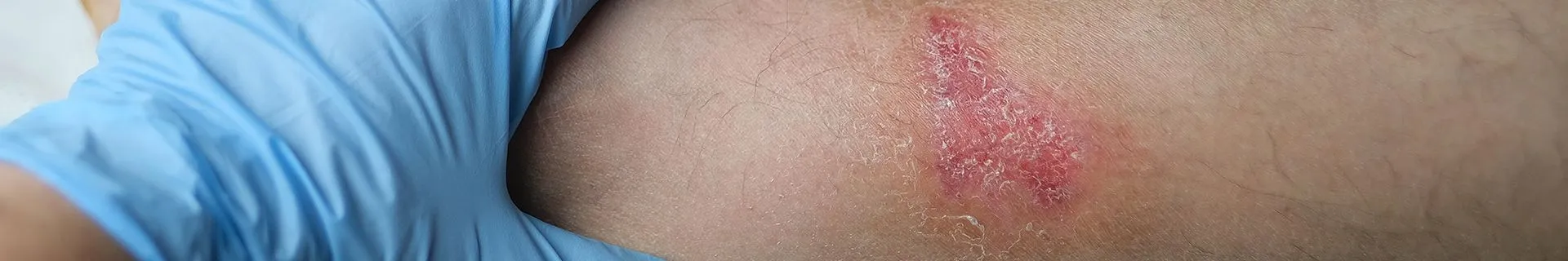 Hot liquid burn injury example for personal injury attorney in Main Line and Greater Philadelphia