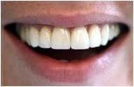 Photograph of smile after Veneers, Gainesville, VA