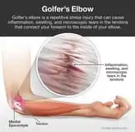 Golfer's Elbow | Basalt, Aspen, Carbondale, Spine Spot Chiropractic