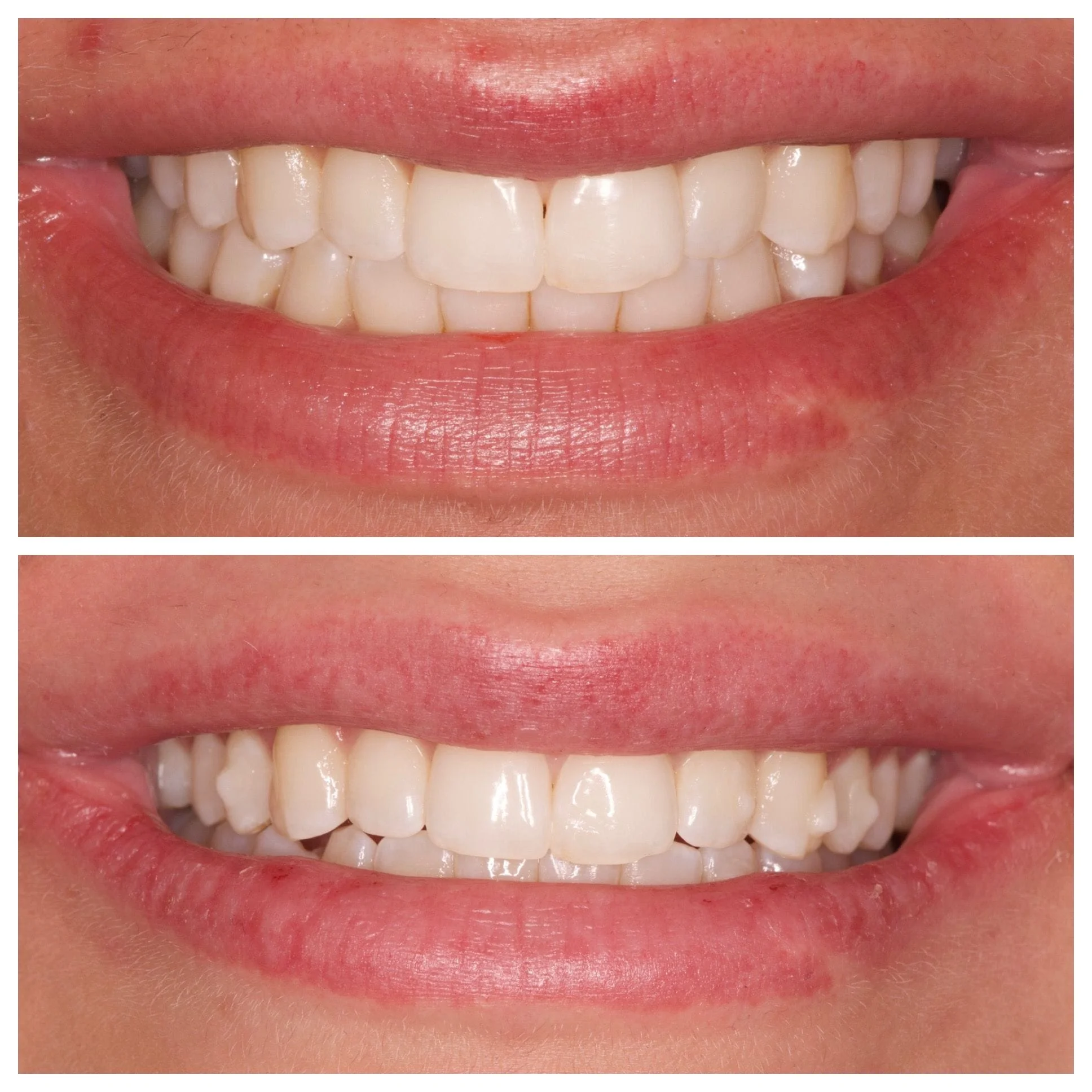 10 WEEK INVISALIGN FOR VERY MINOR SMILE ENHANCEMENT