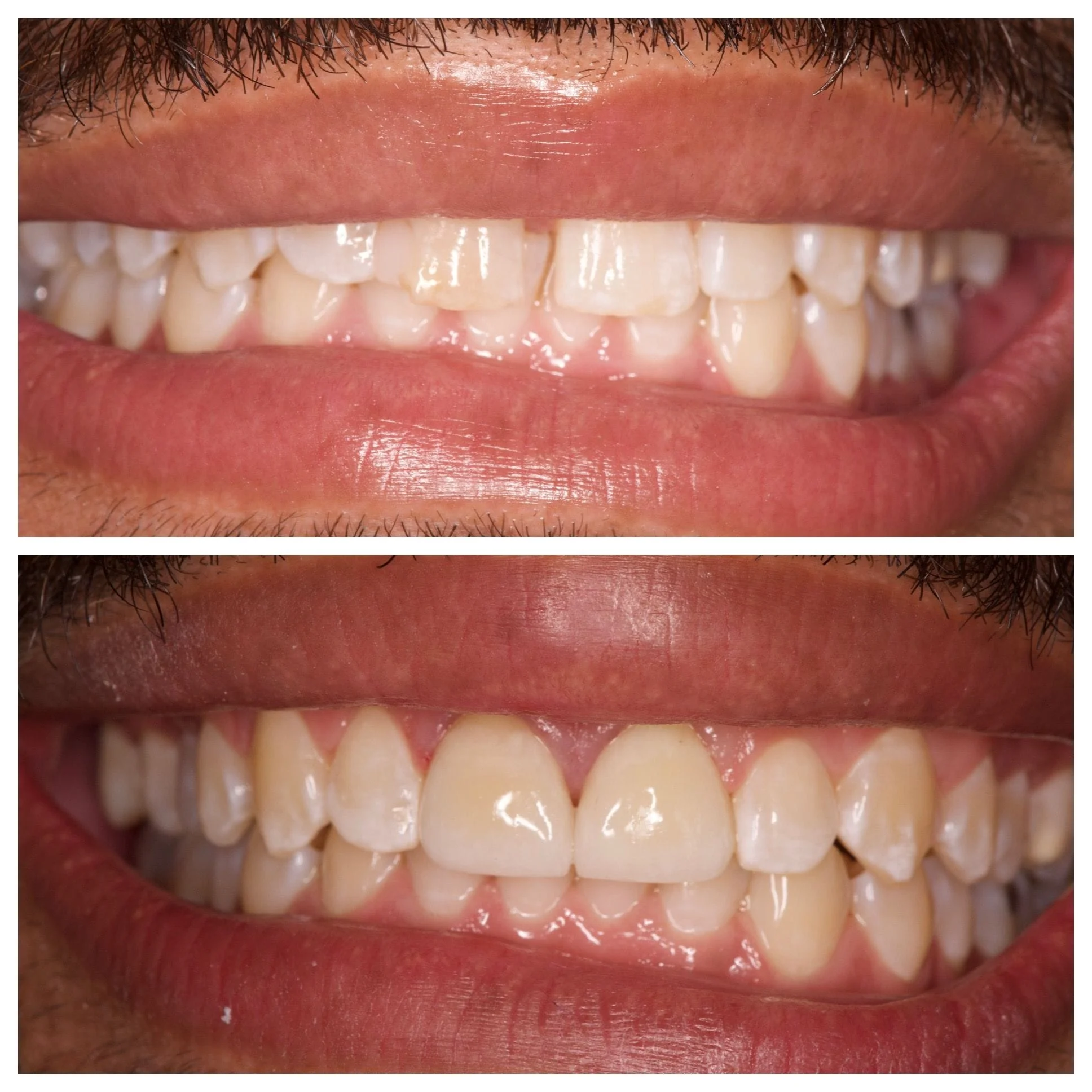 TWO CROWNS TO ENHANCE THE SMILE AND CLOSE THE GAP