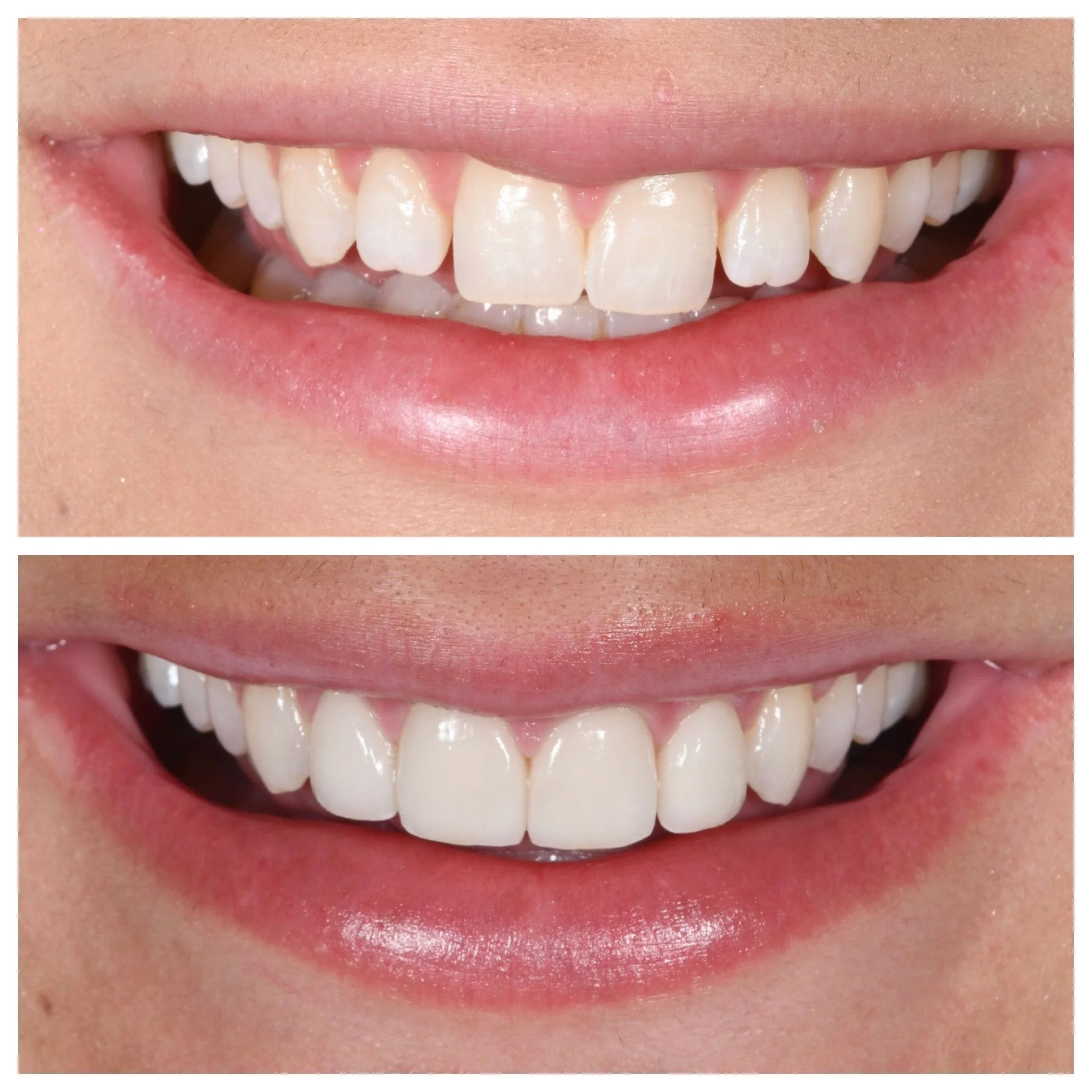 4 veneers to correct size and space