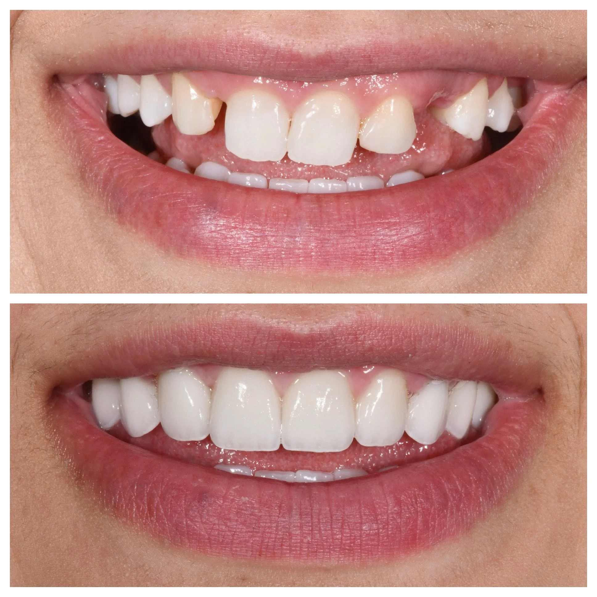 Veneers and implants to replace missing teeth