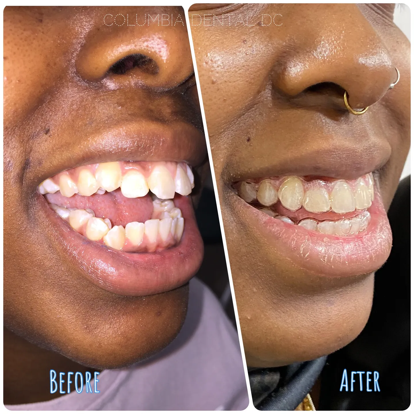 Before and After of our patient treated with Invisalign