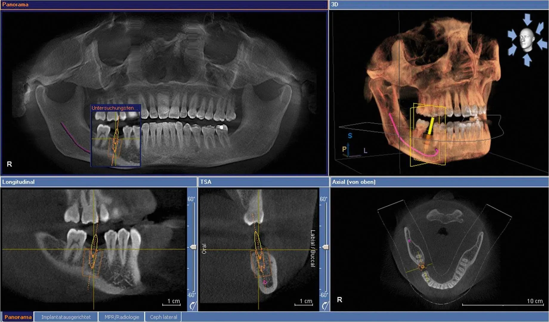 affordable cone beam, cbct scan for implants in foggy bottom washington dc implant