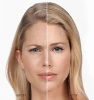 women's Botox before and after results, Urbana, Maryland Botox treatment