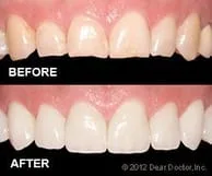 Veneers | Dentist in Newtown, CT | Brookview Dental LLC
