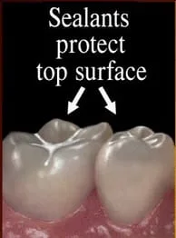 sealants protect teeth from cavities, dentist Mahwah, NJ