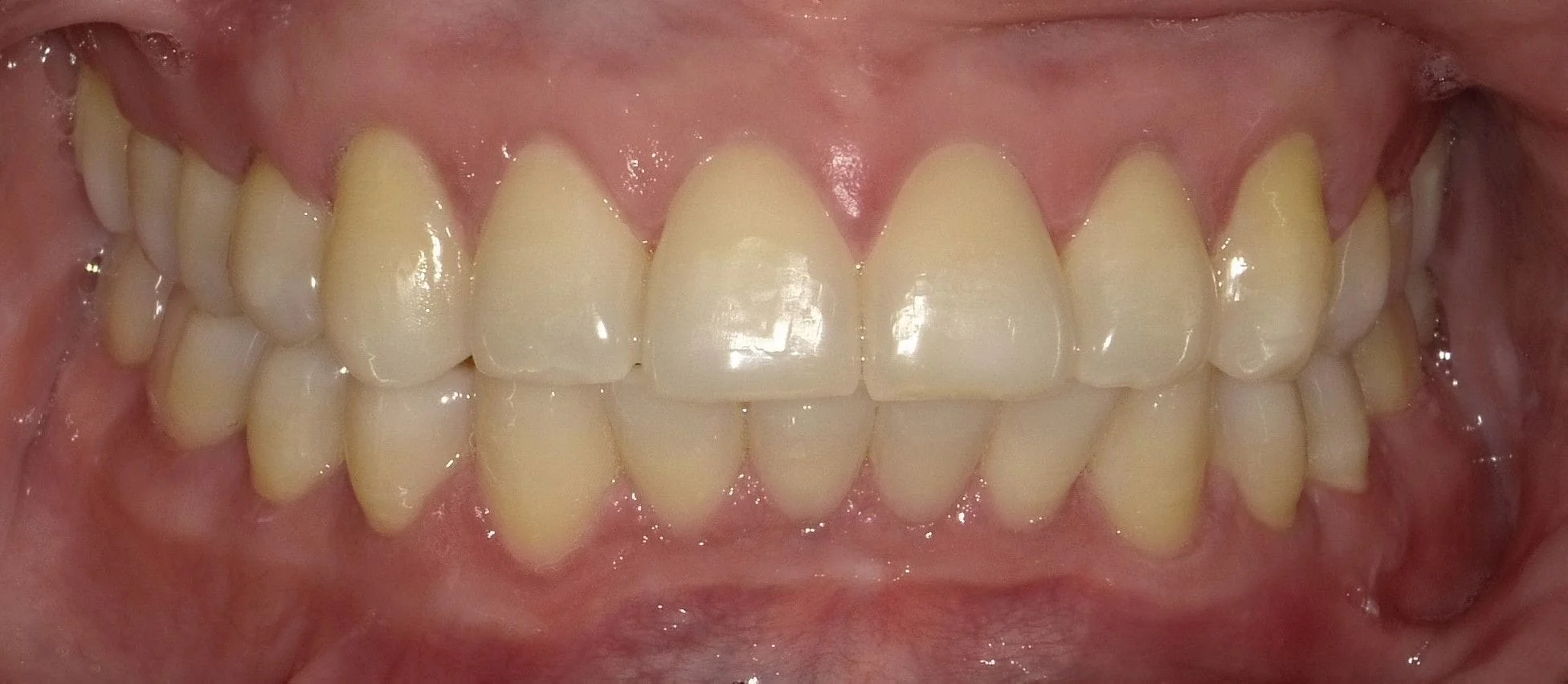 Before And After North York Orthodontics