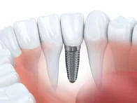 illustration of natural teeth in gums next to embedded implant, Fairfax, VA dental implants South Riding, VA dentist