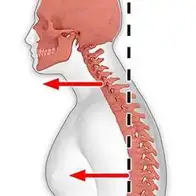forward posture