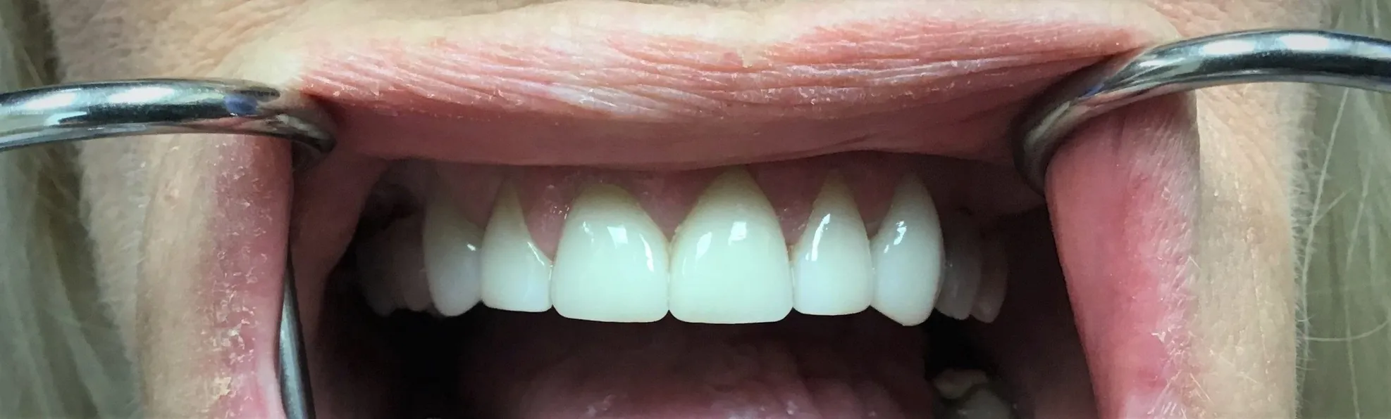 Layered Zirconia Crowns