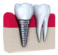 illustration of natural tooth next to dental implant, Baltimore, MD