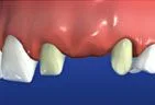 illustration of teeth on either side of missing tooth being prepared for bridge, family dentist Gardnerville, NV
