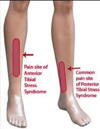 shin splints pain areas