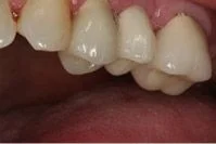 Dental Implants After Portage, MI