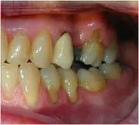 Pittsburgh periodontist before root coverage