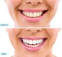 before and after images showing results of professional zoom teeth whitening Melrose, MA cosmetic dentistry