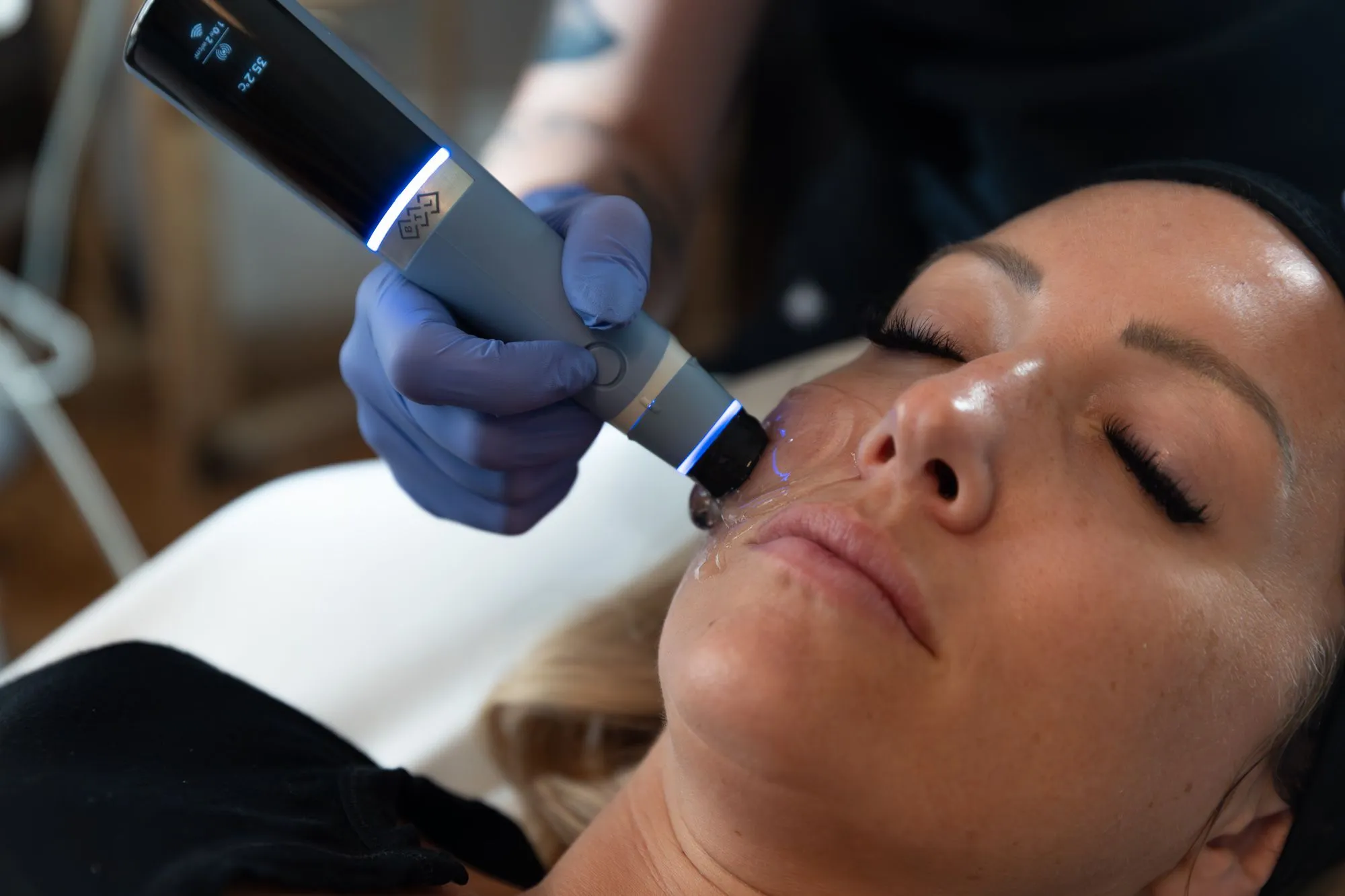 skin tightening treatment with exion in winter park, florida