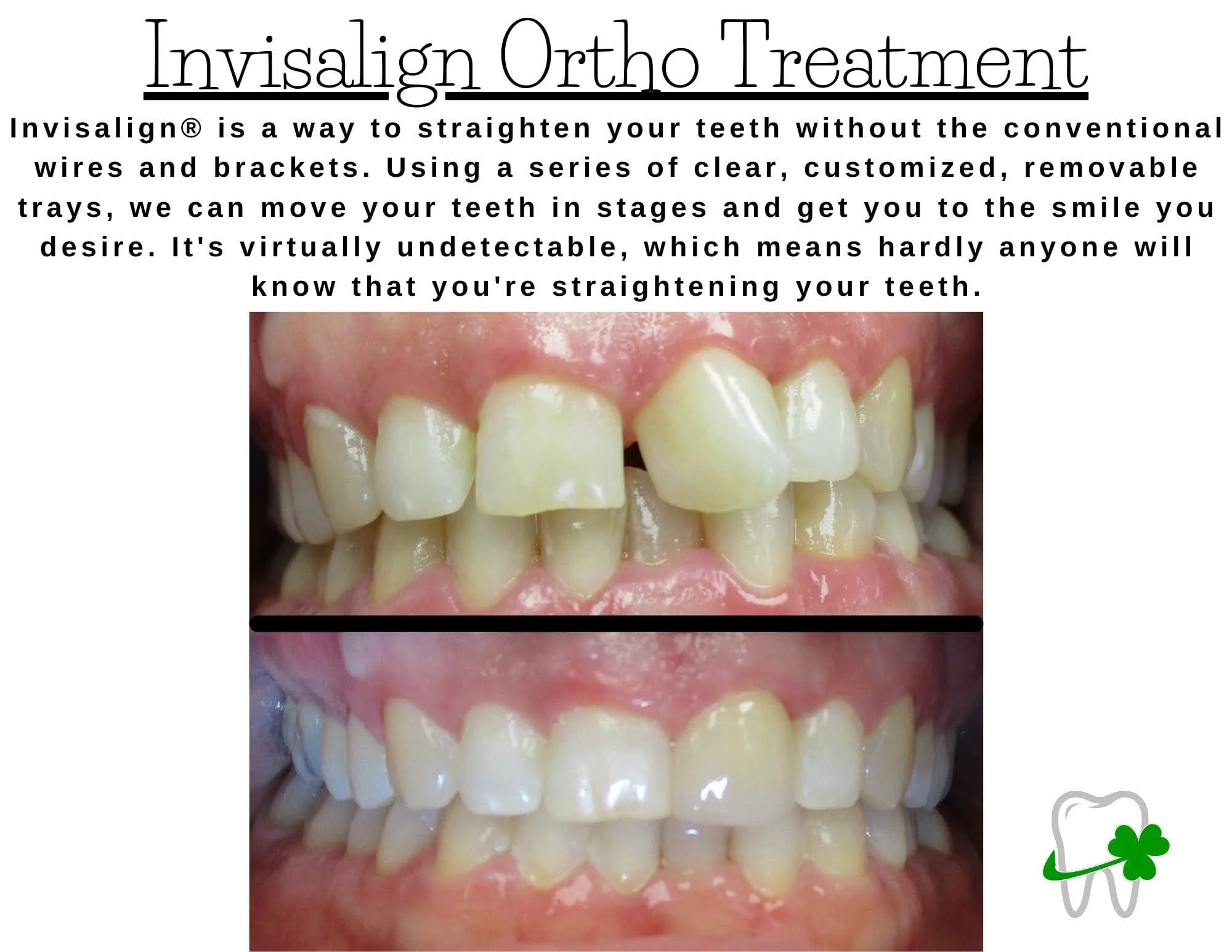 Straighten Your Teeth With Invisalign