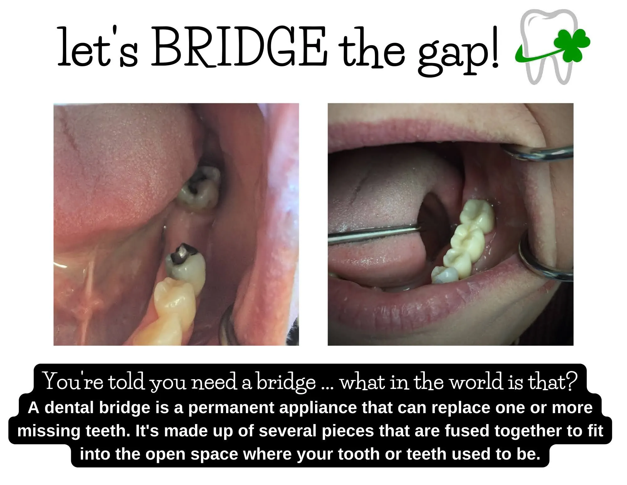 WHAT IS A DENTAL BRIDGE?