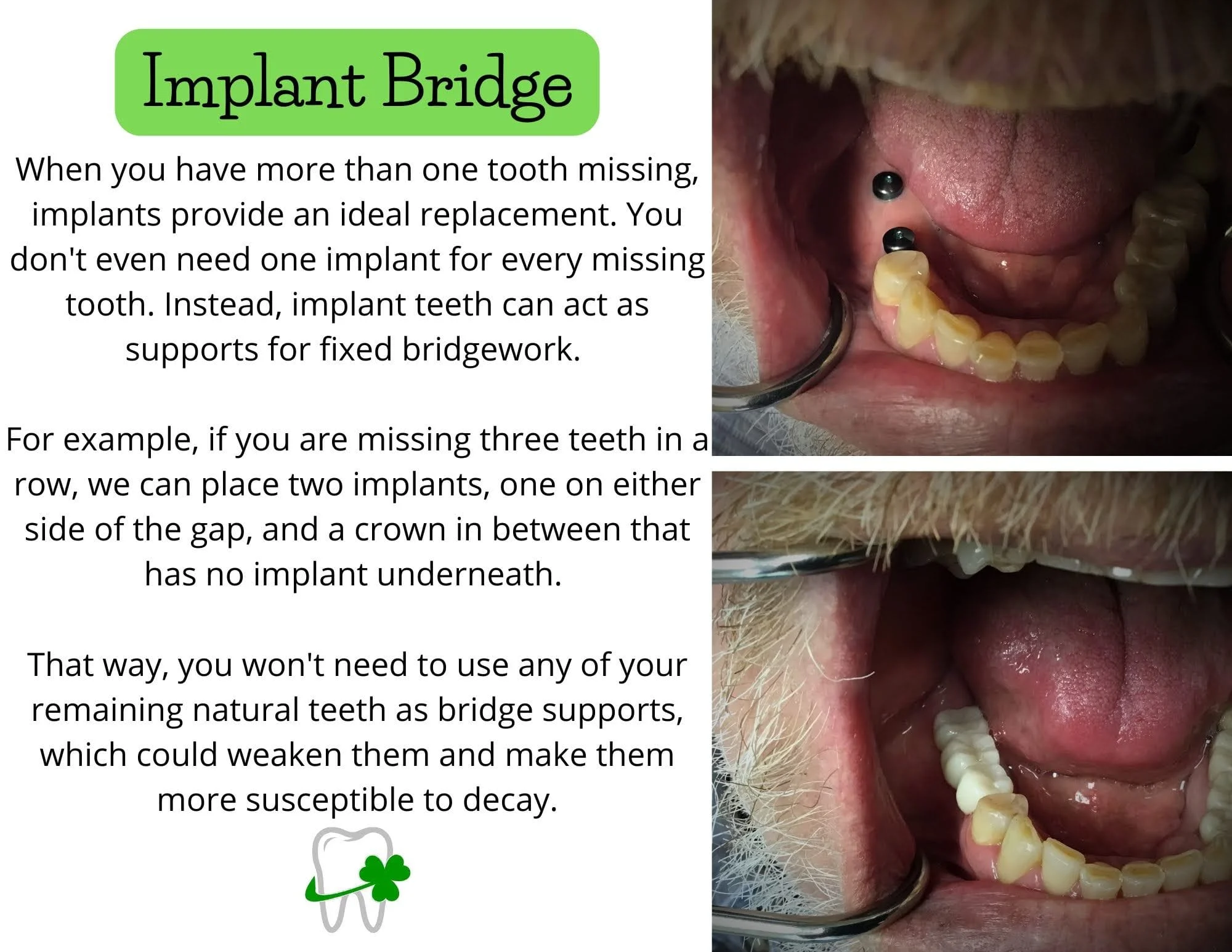 What about a dental bridge?